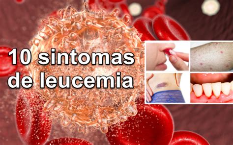 sintomas leucemia - sintomas trigliceridos altos